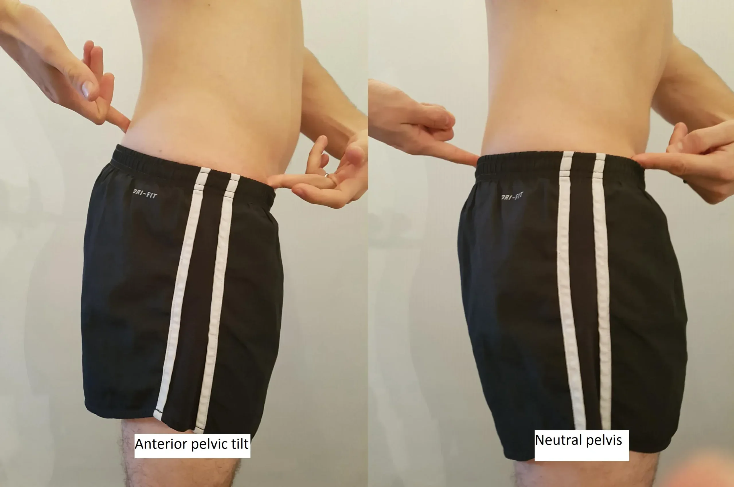 Anterior-pelvic-tilt A photo showing anterior pelvic tilt